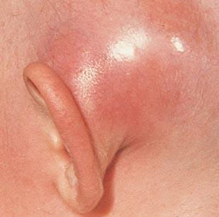 Mastoiditis Subperiosteal abscess