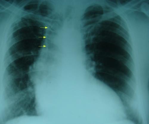 Tracheal shift Tracheal air column is seen shifted to right on X-ray chest PA view.