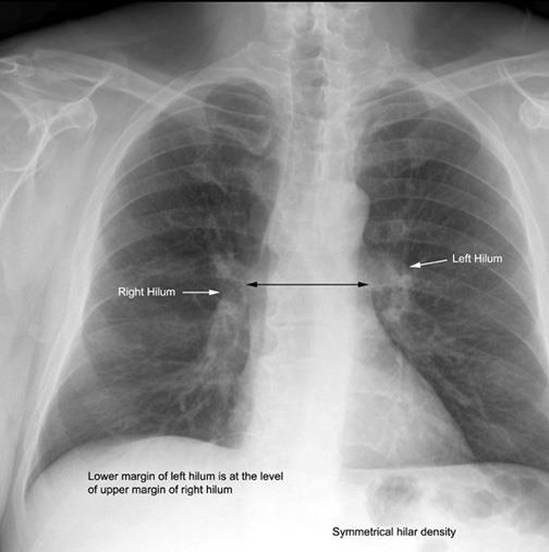 Lungs Lung Roots: Relatively dense shadows caused by the presence of the