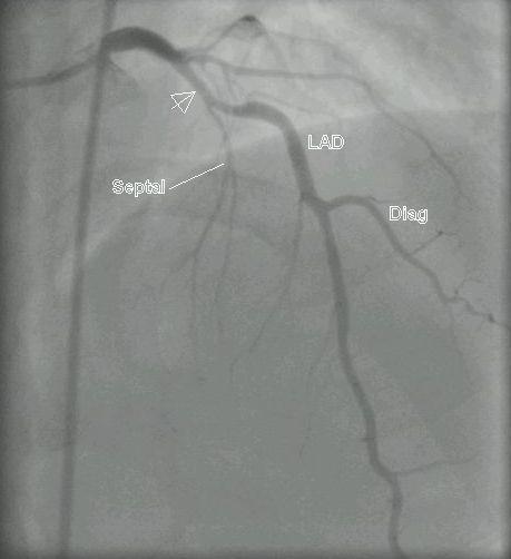 Coronary Angiogram (an