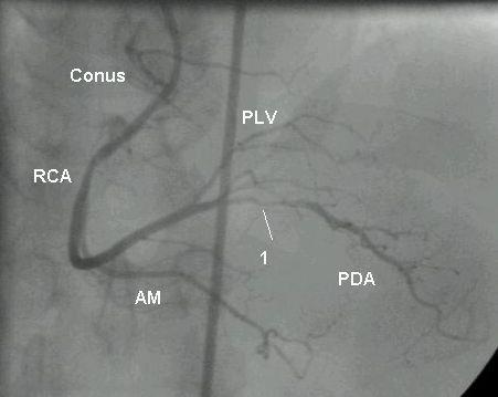 contrast in the coronary