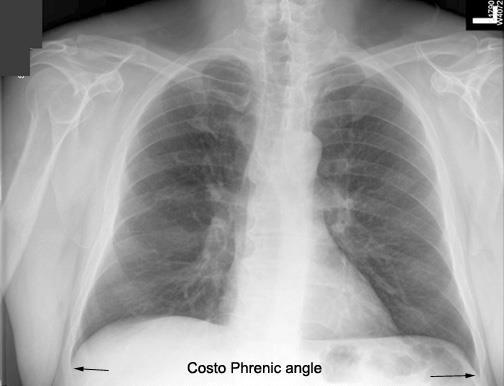 Costo-diaphragmatic (costo-phrenic) Angles They are at the sites where the diaphragm meets the