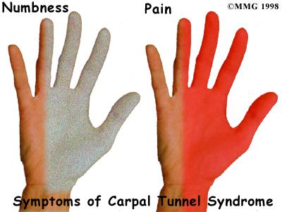 Symptoms Pain in wrist and hand Numbness and tingling in fingers