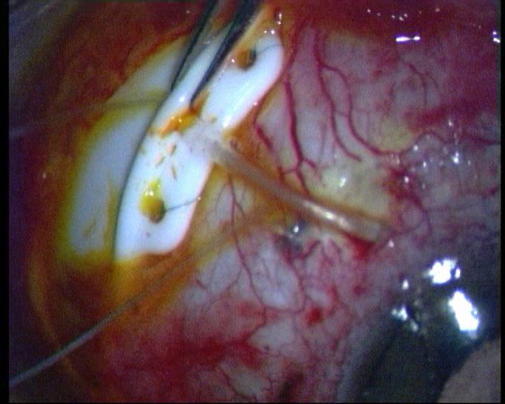 The Baerveldt Glaucoma Implant: A new technique for more