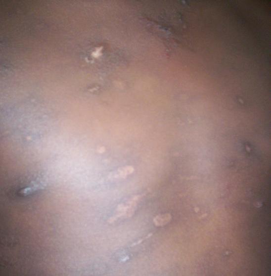 ANNEX A: SKIN AND MOUTH CONDITIONS* SIGNS CLASSIFY TREATMENT UNIQUE FEATURES IN HIV Itching rash with small papules and scratch marks Dark spots with pale centres PAPULAR ITCHING RASH (PRURIGO) Treat