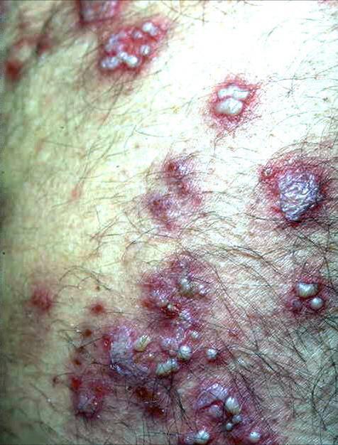 Identify skin problem if skin has blisters / sores / pustules SIGNS CLASSIFY TREATMENT UNIQUE FEATURES IN HIV Vesicles over body Vesicles appear progressively over days and form scabs after they