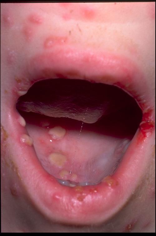 more frequent, chronic infection with continued appearance of new lesions for >1 month; typical vesicles evolve into nonhealing ulcers that become necrotic, crusted, and hyperkeratotic Vesicles in
