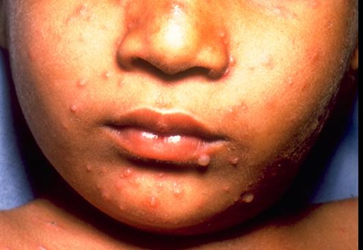 ulceration Rarely recurrent, disseminated or multidermatomal Is a Clinical stage 2 defining disease Vesicular lesion or sores, also involving lips and / or mouth HERPES SIMPLEX If child unable to