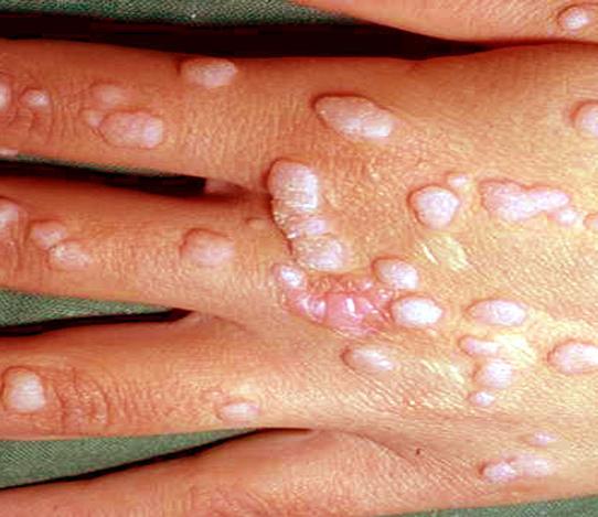 lesion with phenol Electrodesiccaton Liquid nitrogen application (using orange stick) Incidence is higher Giant molluscum (>1cm in size), or coalescent double or triple lesions may be seen More than