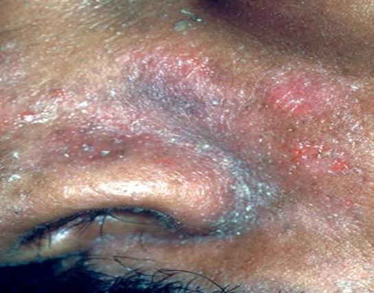 Lesions often chronic and difficult to eradicate Extensive molluscum contagiosum is a Clinical stage 2 defining disease Curettage The common wart appears as papules or nodules with a rough