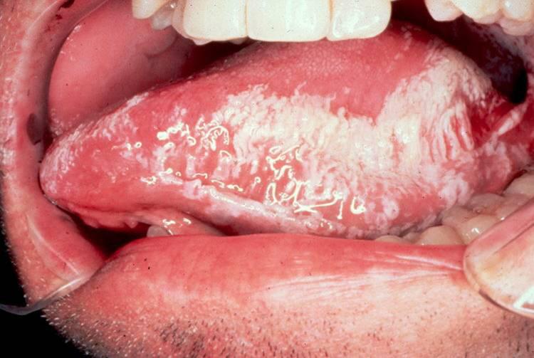 ANNEX A: ASSESS, CLASSIFY AND TREAT SKIN AND MOUTH CONDITIONS Mouth problems : Thrush SIGNS CLASSIFY TREATMENT Not able to swallow SEVERE OESOPHAGEAL THRUSH Refer URGENTLY to hospital.