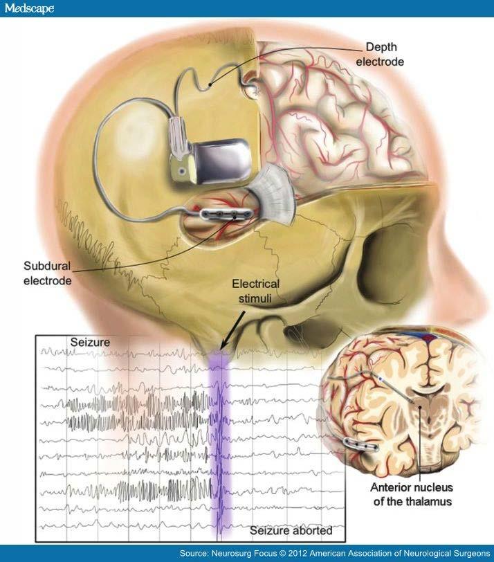 A closed loop system monitors EEG and detects seizure onset delivers electrical impulse to site of seizure origination