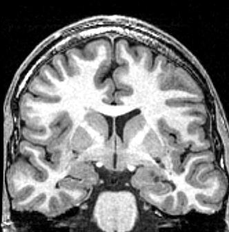 PARTIAL EPILEPSY malformations