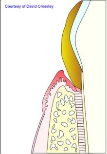 What is periodontitis?