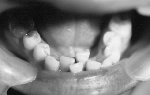The examination of the superficial periodontium shows generalized gingival inflammation with a more severe involvement in the lower frontal area.