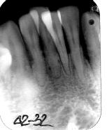 Gingiva bleeds easily on probing, with a PBI score 3 for the lower region and 2 for the rest of the arch.