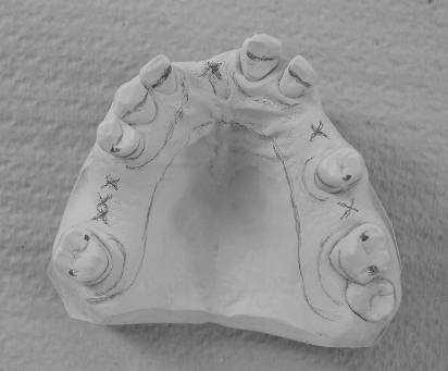 partial denture, outline the saddle