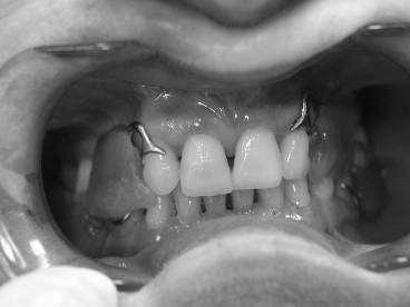 relationship with wax occlusal rim and