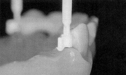 milling with a cervical and/or occlusal shoulder allows a