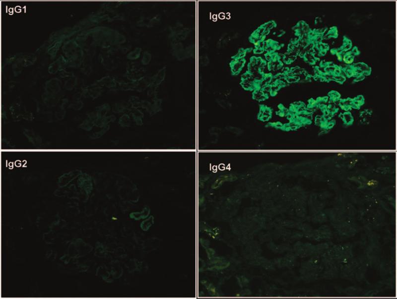 IF staining for the IgG subtypes performed on the first transplant biopsy with recurrence in patient #3 shows intense glomerular positivity for IgG3 with negative staining for IgG1, IgG2, and IgG4 (