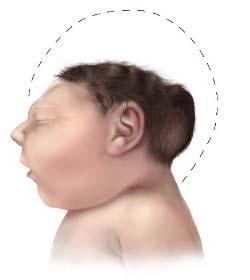 Description Inclusions Exclusions ICD-9-CM Codes Fetal Brain Disruption Sequence Fetal brain disruption sequence is a pattern of congenital abnormalities that include severe microcephaly, overlapping