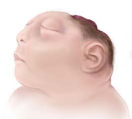 Neural Tube Defects and Other Early Brain Malformations Description Anencephaly/Acrania Anencephaly Partial or complete absence of the brain and skull.