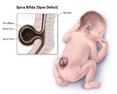 Description Spina Bifida without Anencephaly Incomplete closure of the vertebral spine (usually posteriorly) through which spinal cord tissue and/or meninges (membranes that cover the spine) herniate.