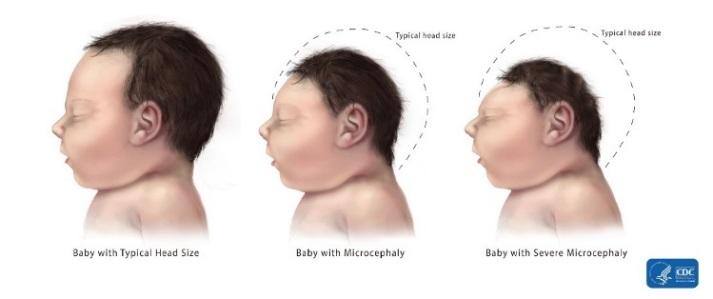 Brain Abnormalities with and without Microcephaly Description Microcephaly Microcephaly, or microcephalus, is the clinical finding of a small head when compared with infants of the same sex and age.