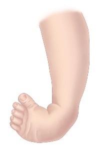 Description Clubfoot with associated brain abnormalities An abnormality of the foot consisting of plantar flexion (downward pointing of the foot and toes), inversion (internal rotation, or varus),