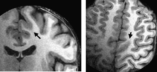 SEIZURE SEMIOLOGY AND MRI IN MIDLINE SPIKES 1567 FIG. 2.
