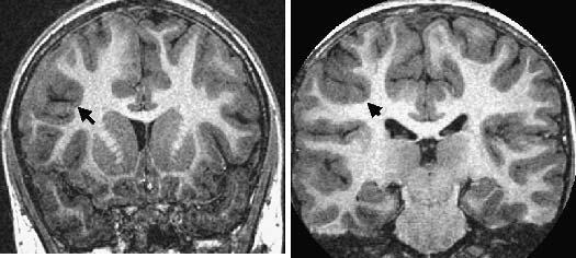 (B) frontal lobe. found to propagate to the medial temporal lobe and manifest as complex partial seizures (10,11). Tonic motor seizures were the second most common seizure.