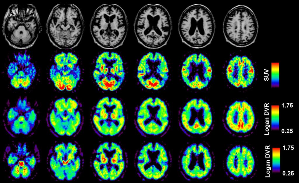 Β-Amyloid Imaging MRI [ 18 F]FDG [ 11