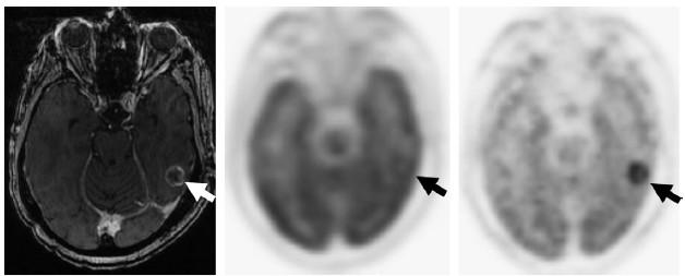 Neurooncologic processes MRI, T1 post-contrast Early phase, FDG-PET (60 min)