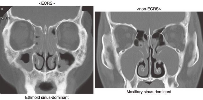 very high Endonasal findings bilateral polyps, CT findings ethmoid