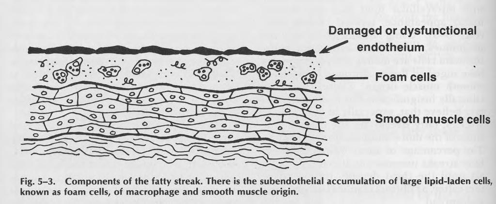Fatty streaks contain macrophage cells with lipid deposits Foam cells=macrophages that have engulfed fatty material