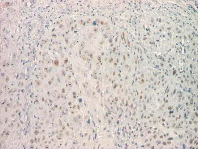 (immunostaining between 25 50% of the neoplastic cells), ob.