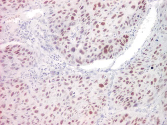 (immunostaining between 50 75% of the neoplastic cells), ob.