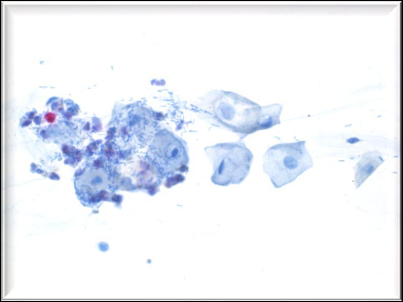 : Conventional smear, LSIL with Koilocyte 40x