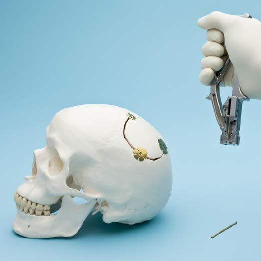 Repeat Steps 6 8 for remaining implants. Implant Removal Implant removal Instrument 398.96.98 Stagbeetle Forceps, 125 mm Use the stagbeetle forceps to grasp between the petals of the top disk.