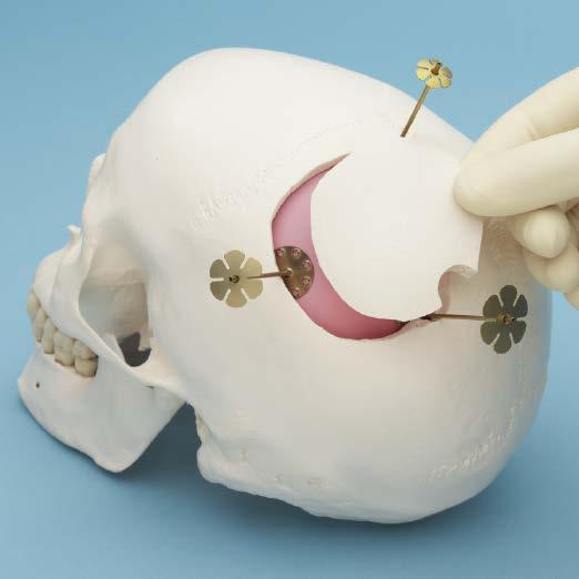 Operating Technique 3 Replace cranial bone flap Replace the bone flap to its original position.