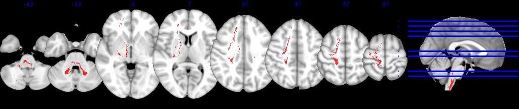 Missing Connectivity of the Right Locomotor Network and bilateral Cerebellum in Freezers R L FoG subjects show