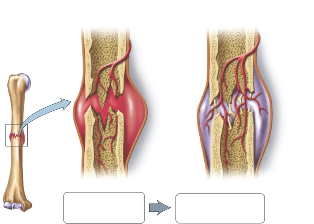Bone Fractures are Healed by Fibroblasts and Osteoblasts Formation of blood clot Formation of cartilaginous callus Cartilaginous callus Blood clot (hematoma)