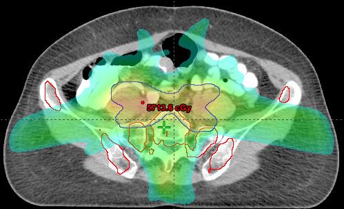 Prospective BM-Sparing IMRT Studies Prospective Pilot Study 30 patients with cervical/anal cancer FDG-PET + IDEAL Published - Liang IJROBP 2012 IG-BMS IMRT dosimetrically and clinically feasible