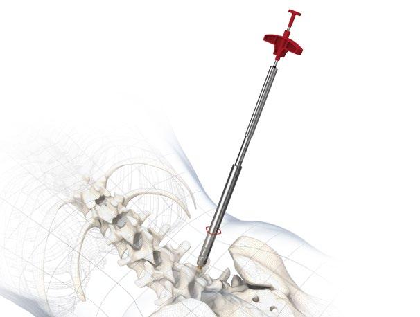 PRODUCT INFORMATION Surgical technique 8a Optional augmentation Use augmentable DIPLOMAT screws together with low-viscosity bone cement for vertebroplasty.