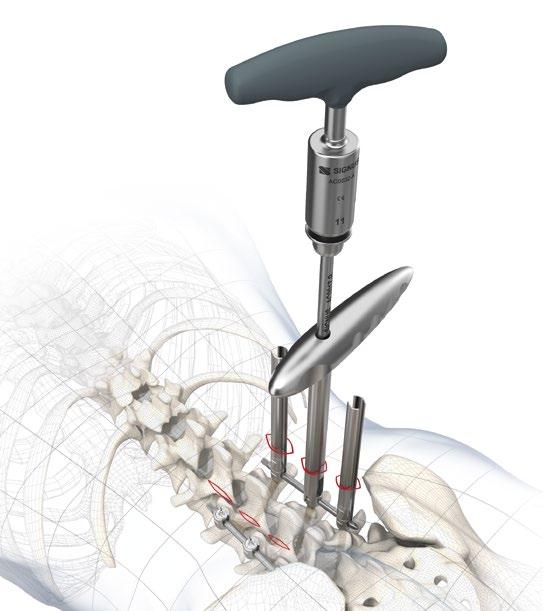 PRODUCT INFORMATION Surgical technique 13a Optional Distraction and compression Before the set screws are definitively tightened using the torque limiter (AC0017 and AC0032), distraction or