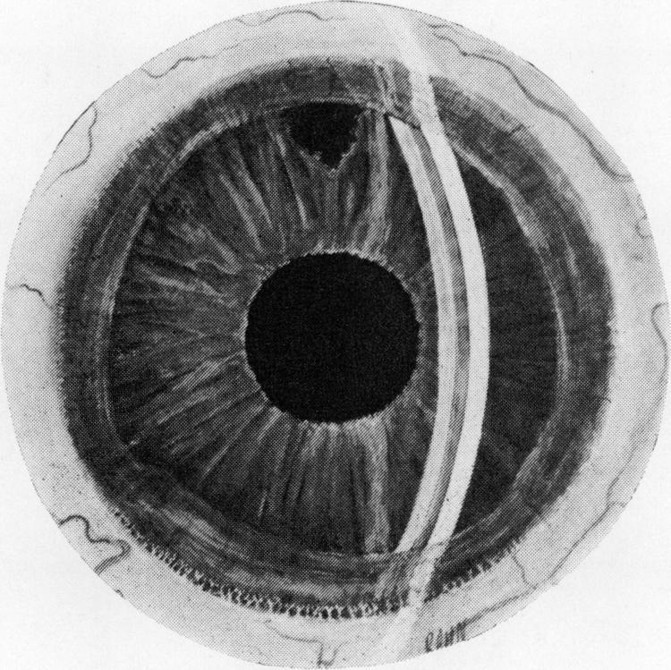 Brit. J. Ophthal. (I970) 54, 410 "Contact lens" cornea in rheumatoid arthritis A. J. LYNE Peterborough District Hospital It has been noted that patients suffering from long-standing rheumatoid arthritis often display a characteristic corneal lesion.