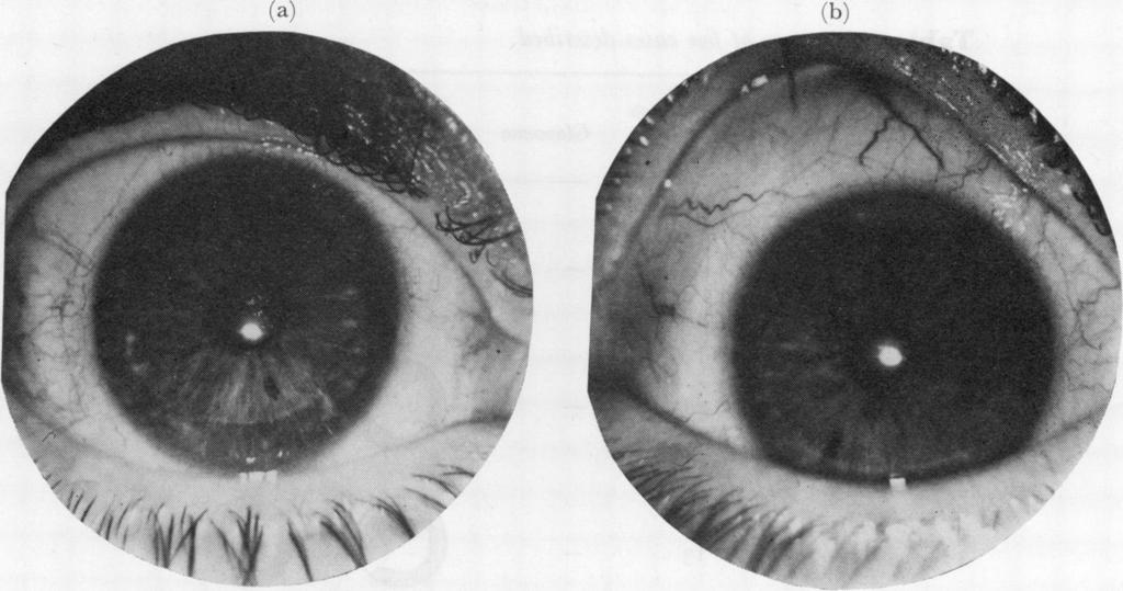 412 FIG. 2 Case 2. Photograph of right eye (a) and left eye (b) A. j. Lyne Case 3, a woman aged 62 years, attended because of pain in the right eye for the previolus month.