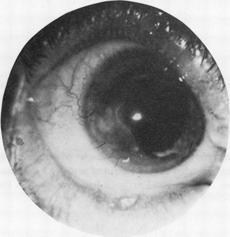 She had suffered from rheumatoid arthritis for I3 years with multiple joint deformities. The right eye showed the characteristic band of opacity on the cornea extending from 5 o'clock to I 2 o'clock.