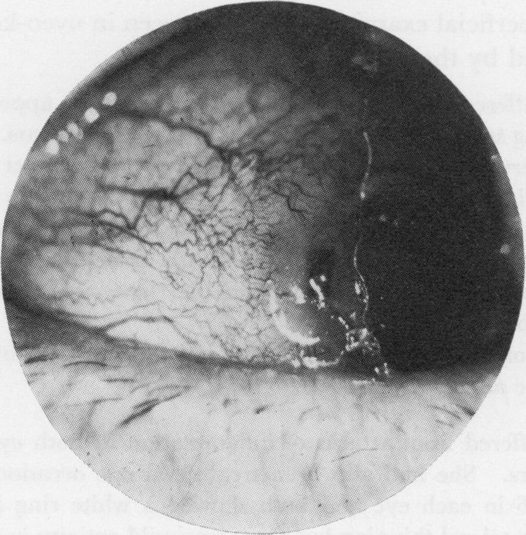 "Contact lens" cornea in rheumatoid arthritis Case 4, a woman aged 62 years, had suffered from recurrent corneal ulceration of the left eye for about 4 years.