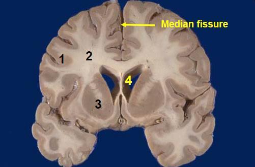 Supero-medial border Septum pelluidum Corpus Callosum Third Ventricle -If we take a coronal section of the brain, we can see the following structures: 1) Grey matter. 2) White matter. 3) Basal nuclei.